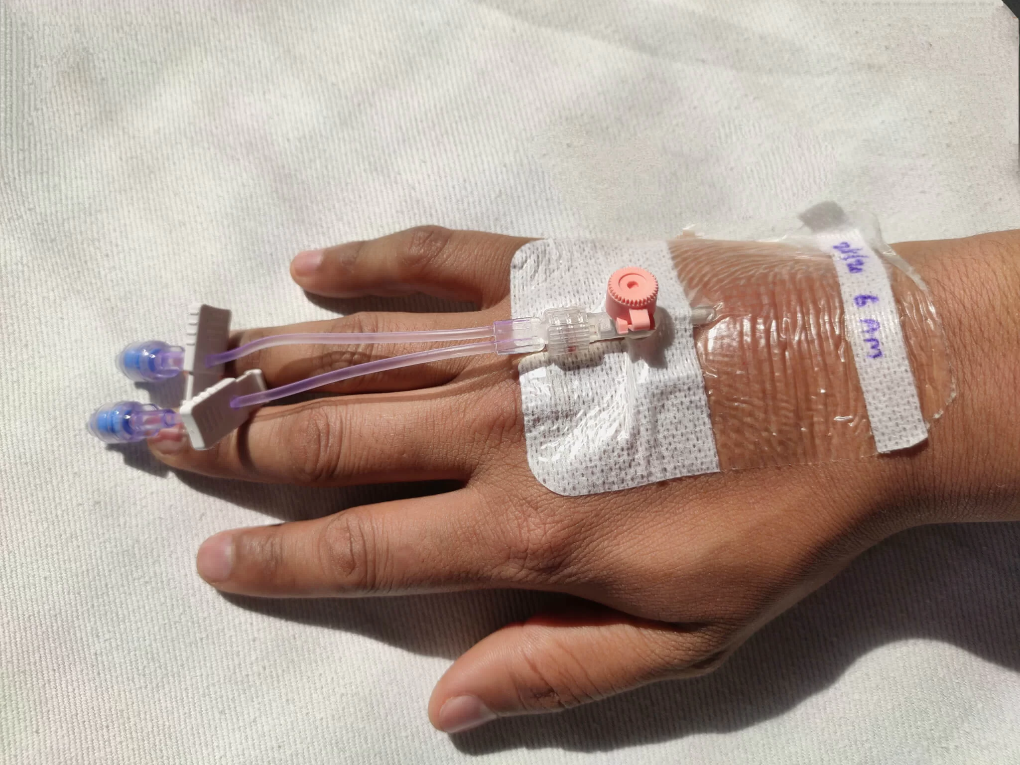 The risk of extravasation injuries during iron infusion therapy