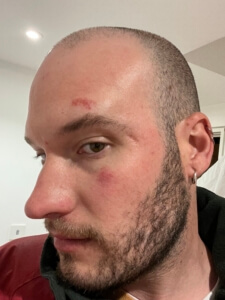 head injury - elliot lime case 